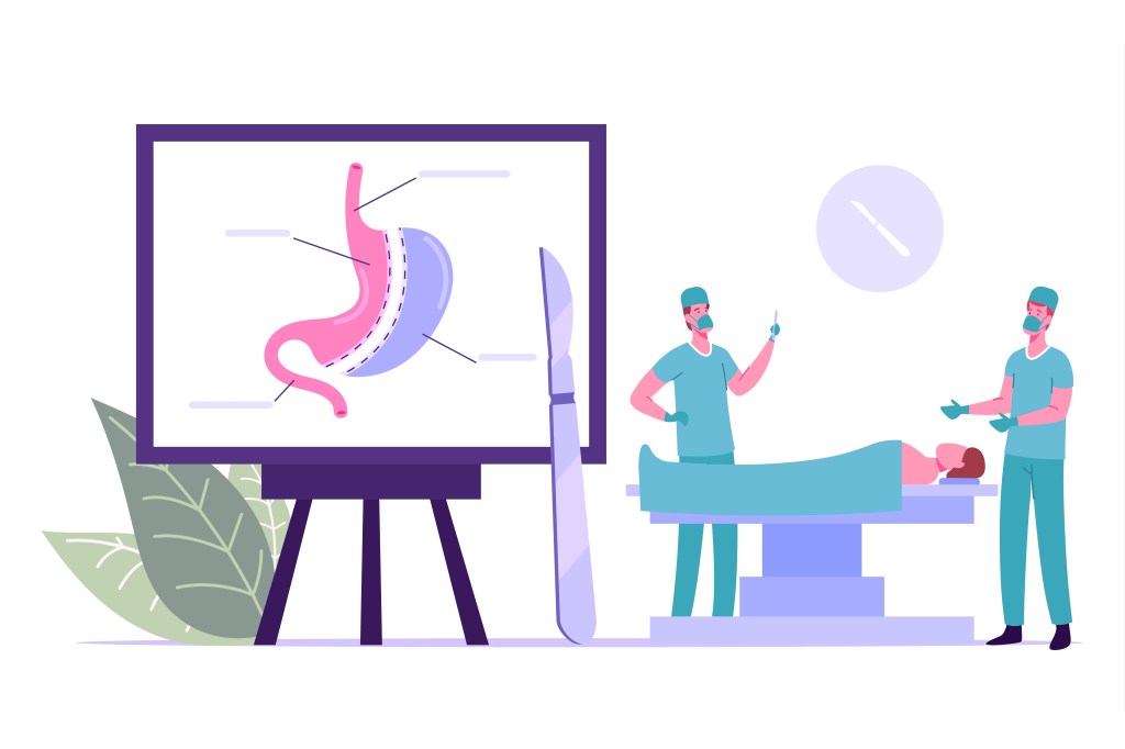 Un tableau montrant le schéma de l'estomac avec des chirurgiens en action lors d'une opération de chirurgie bariatrique sur une table d'opération.